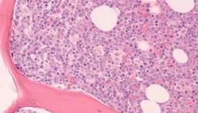 hematologia-coi-carrusel-leucemia