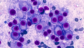 hematologia-coi-carrusel-mieloma