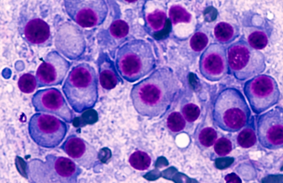 hematologia-coi-mieloma-multiple-img1