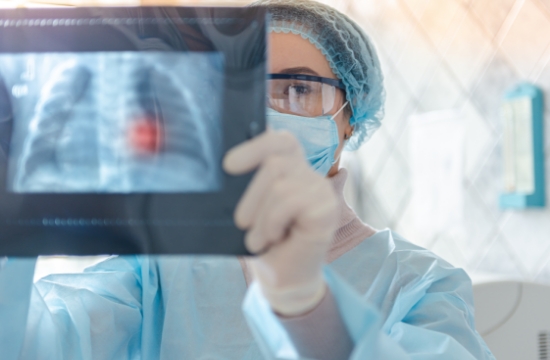 cancer-de-pulmon-coi-img3