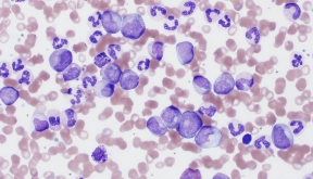 hematologia-coi-carrusel-mieloproliferativas